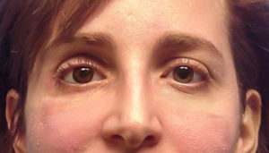 ENUCLEATION (1)