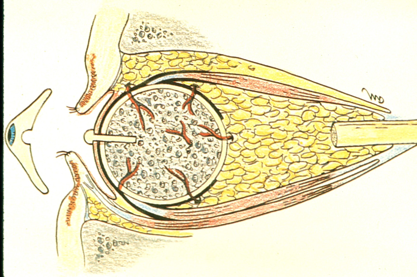 ENUCLEATION (3)
