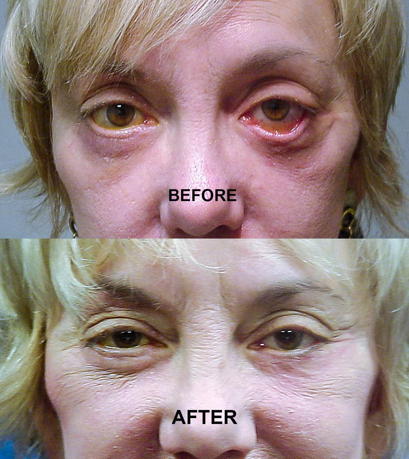 EYELID RETRACTION LENZ