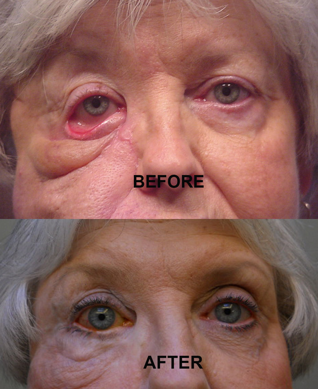 Eyelid Deformity (2)