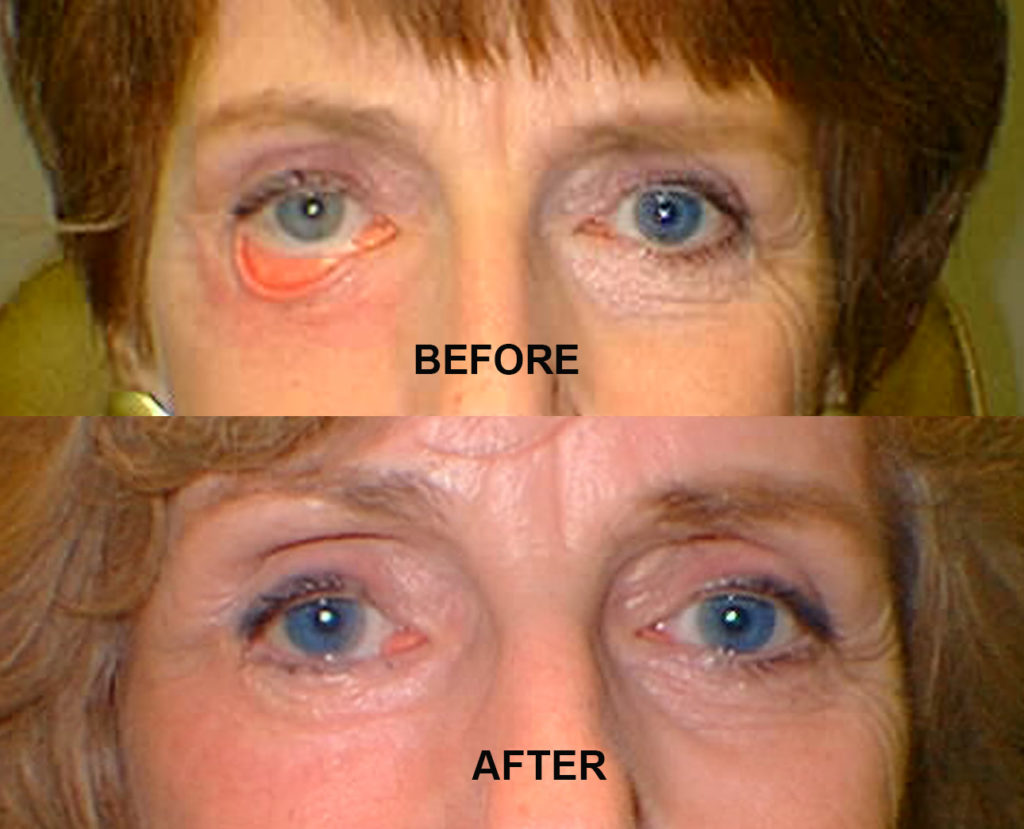 Eyelid Deformity (3)