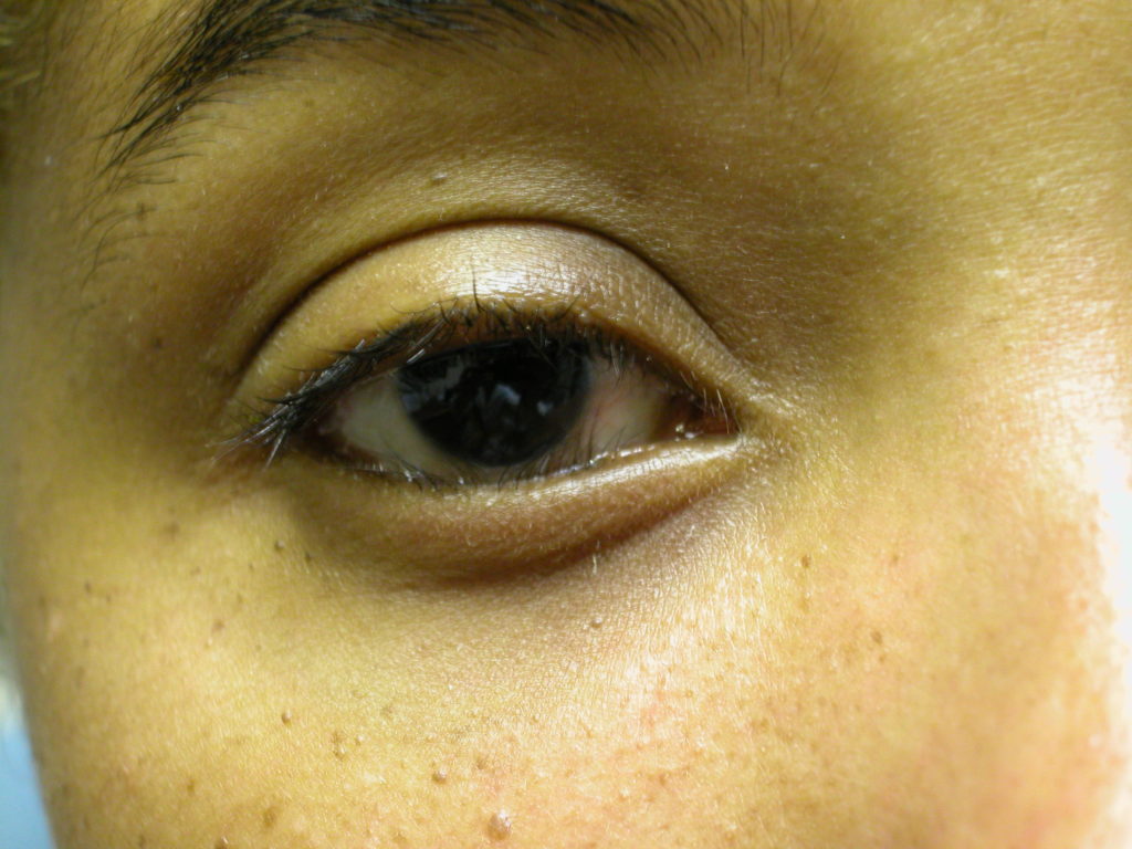 Eyelid Deformity (4)