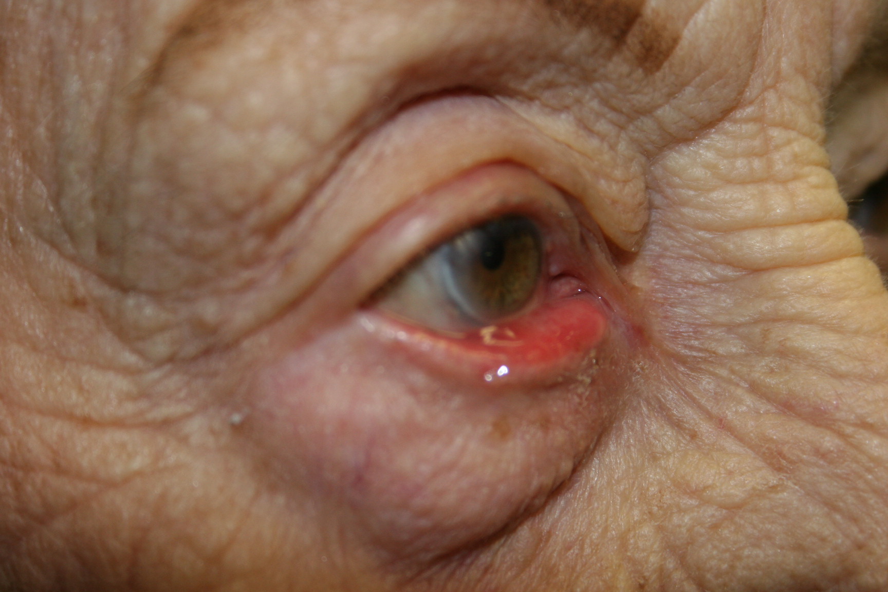 Eyelid Deformity (6)