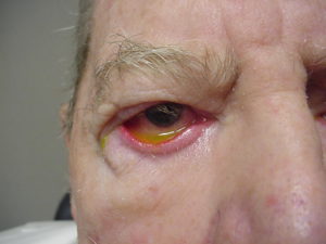 Eyelid Deformity (7)