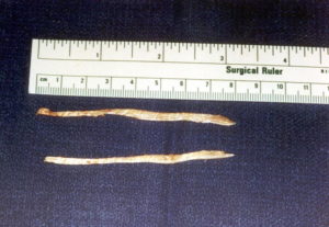 FASCIA LATA STRIPS