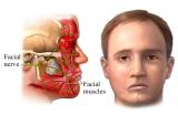 Facial N palsy right
