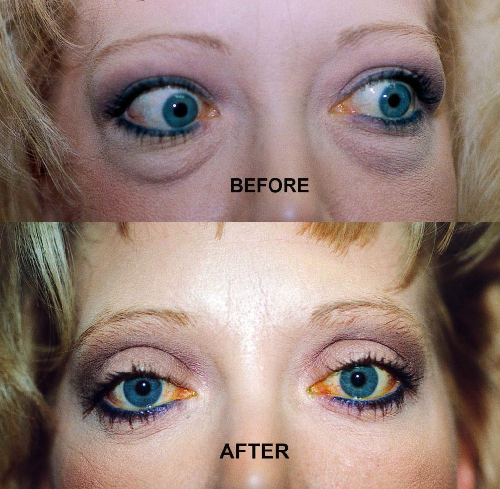 GRAVES DISEASE 4