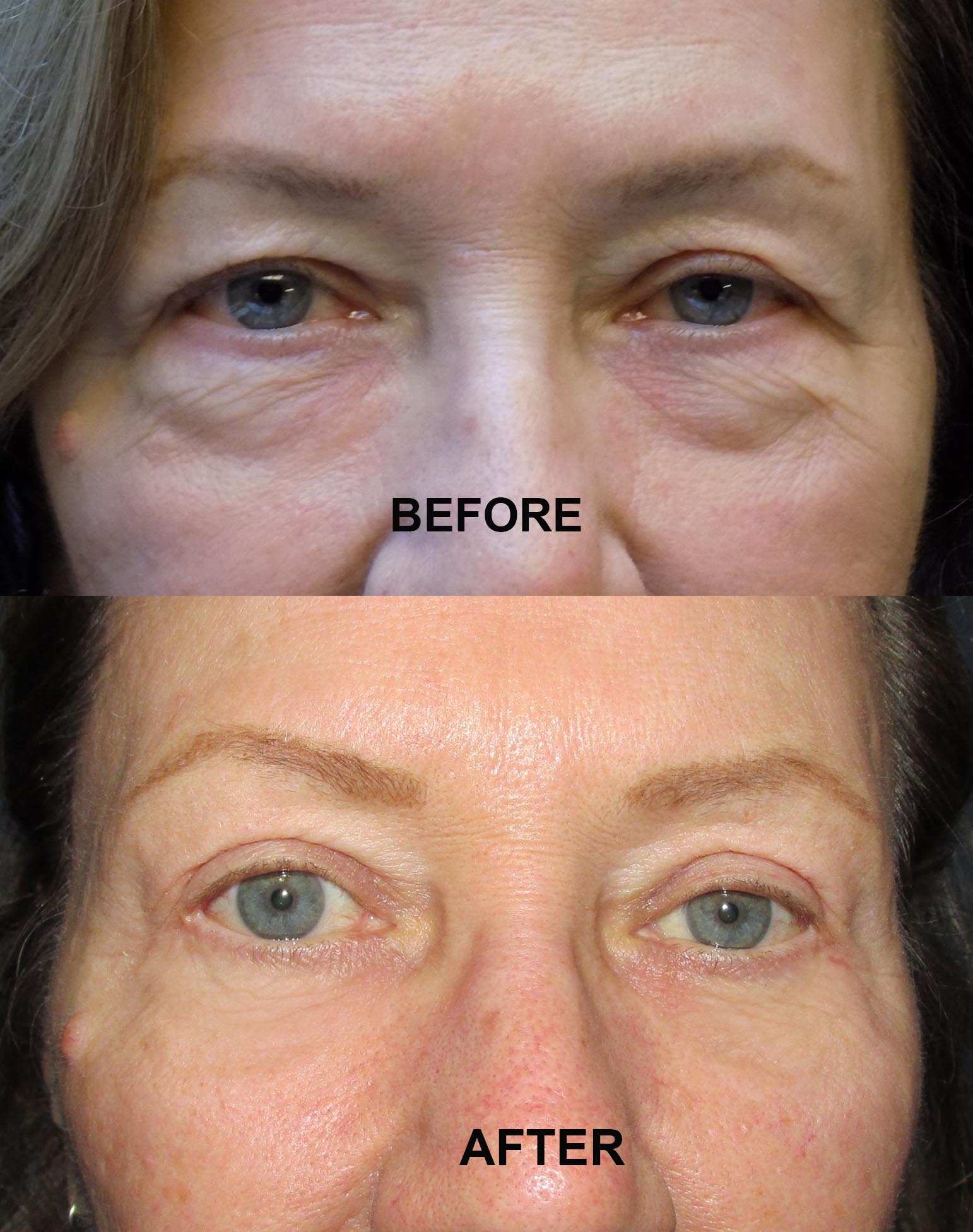 LOWER BLEPHAROPLASTY 18