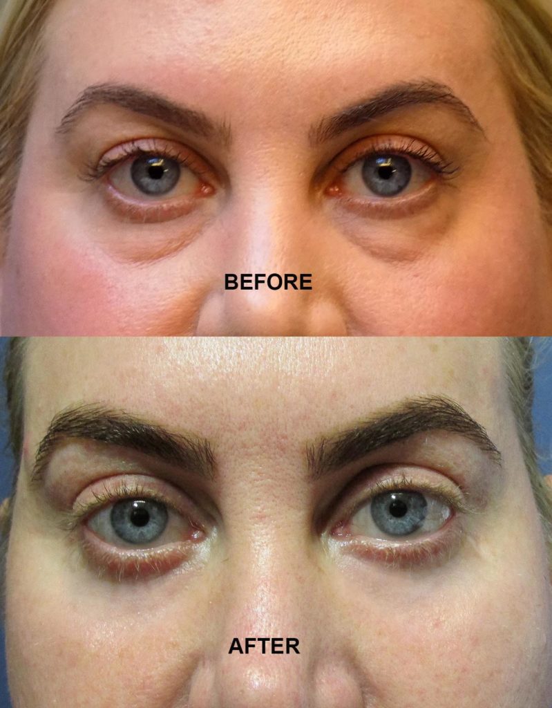 Lower Eyelid Blepharoplasty (5)