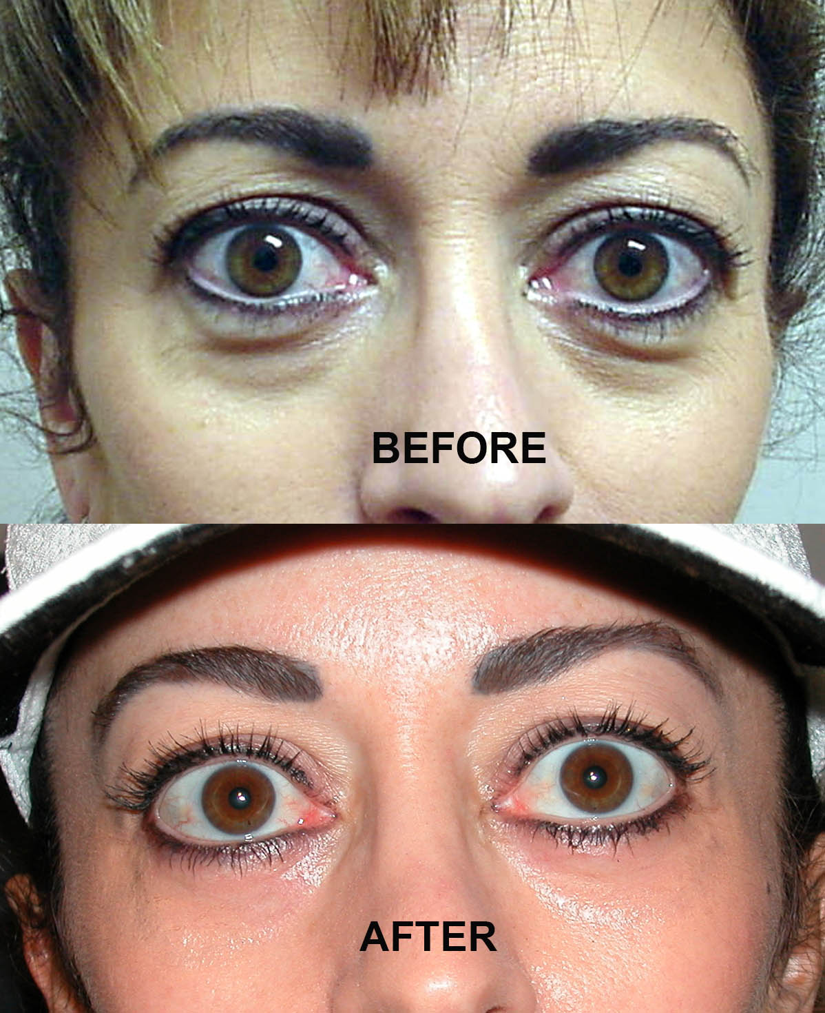 Lower Eyelid Blepharoplasty (7)