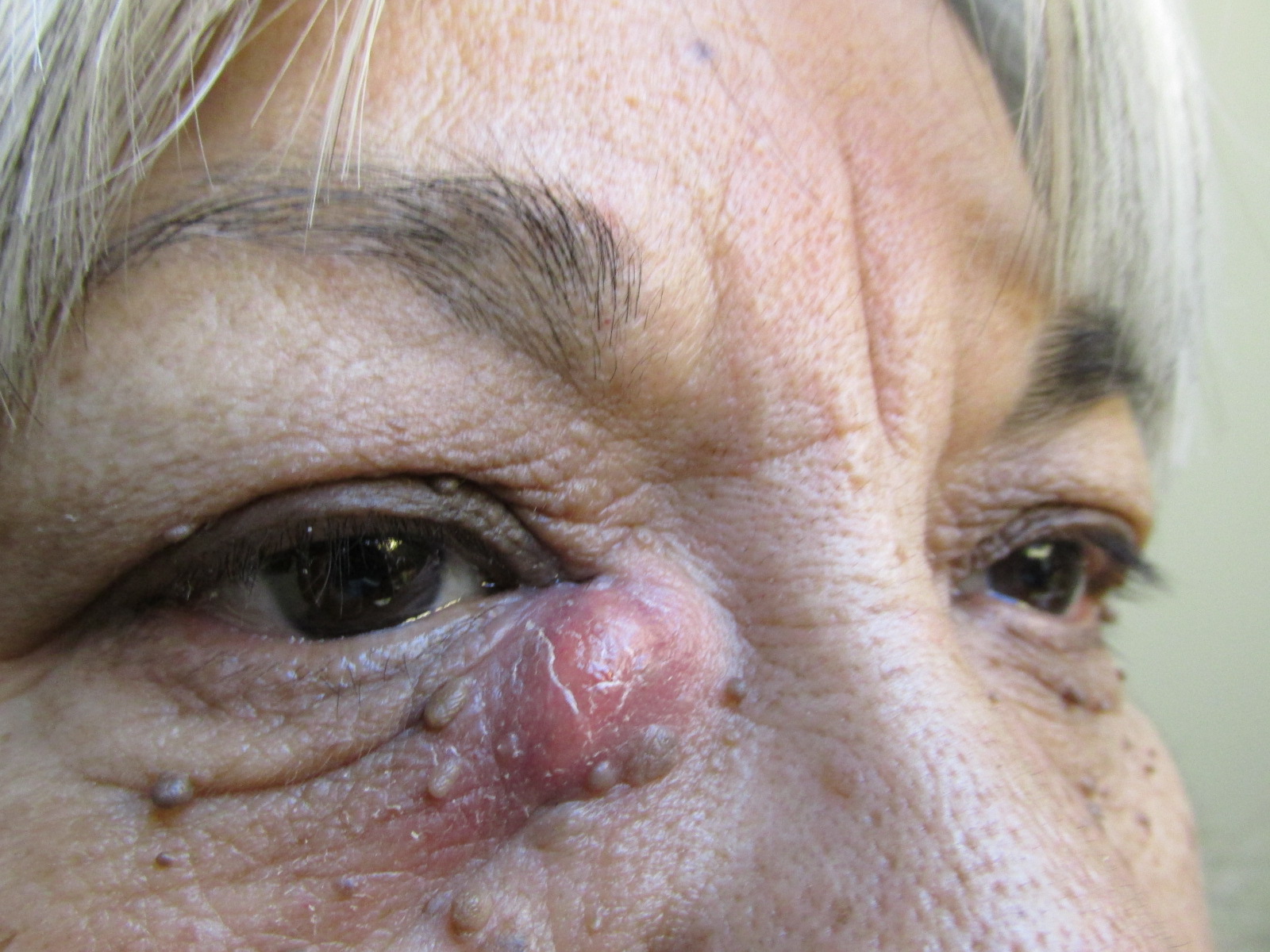 Martinez G Dacryocystitis (2)