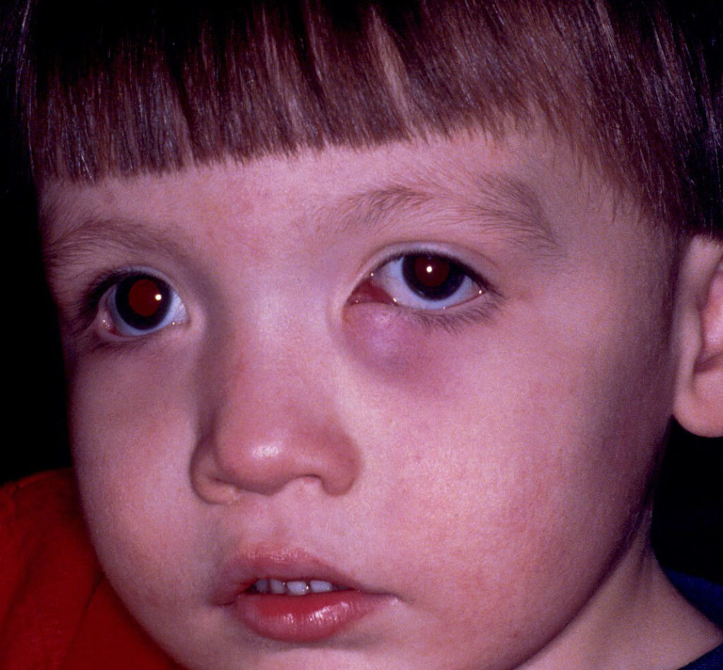 ORBITAL TUMOR (1)