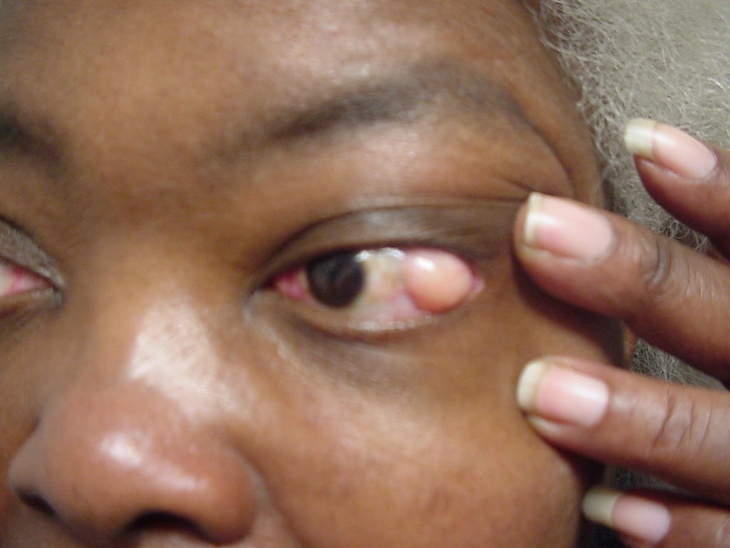 ORBITAL TUMOR (10)