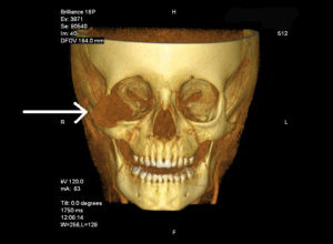 ORBITAL TUMOR (15)