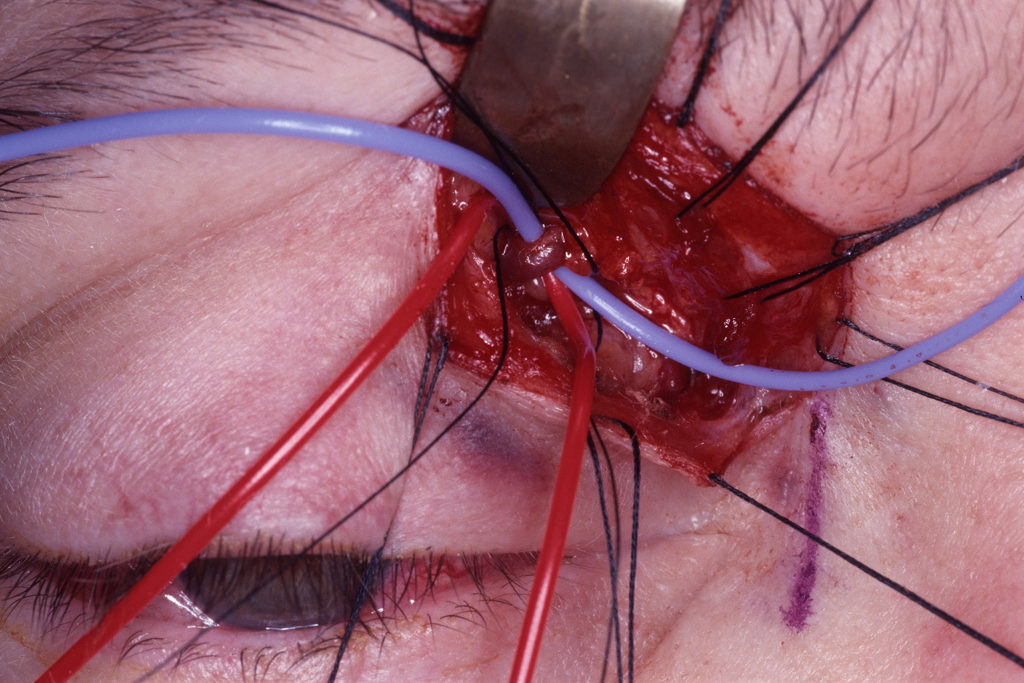 ORBITAL TUMOR (17)