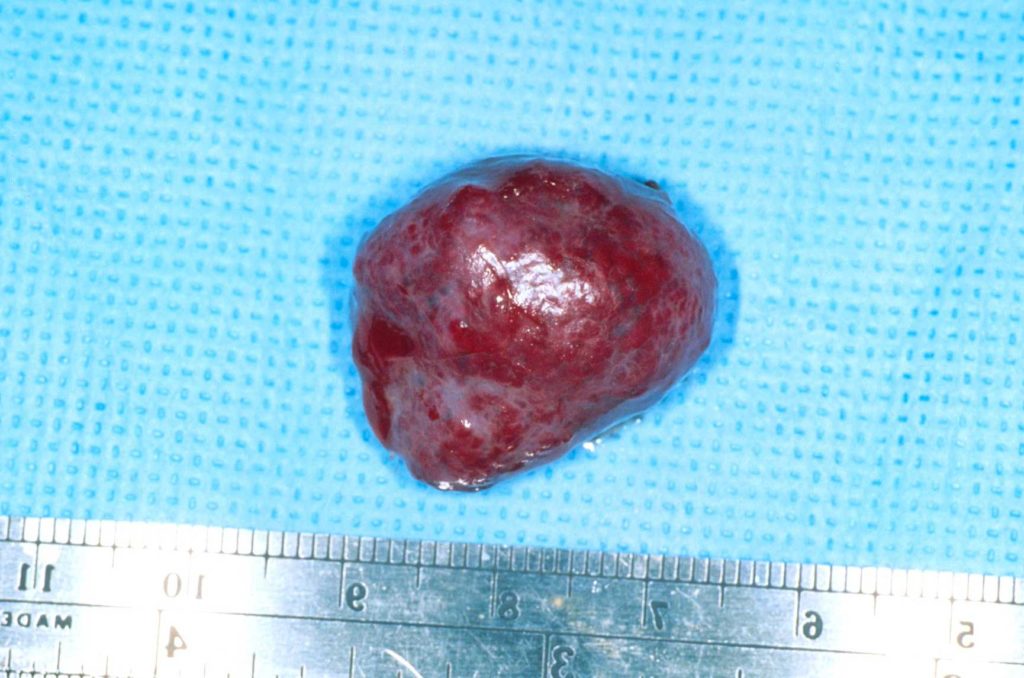 ORBITAL TUMOR (3)