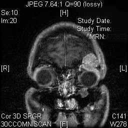 ORBITAL TUMOR (7)