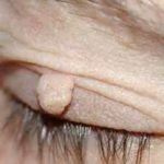 PAPILLOMA