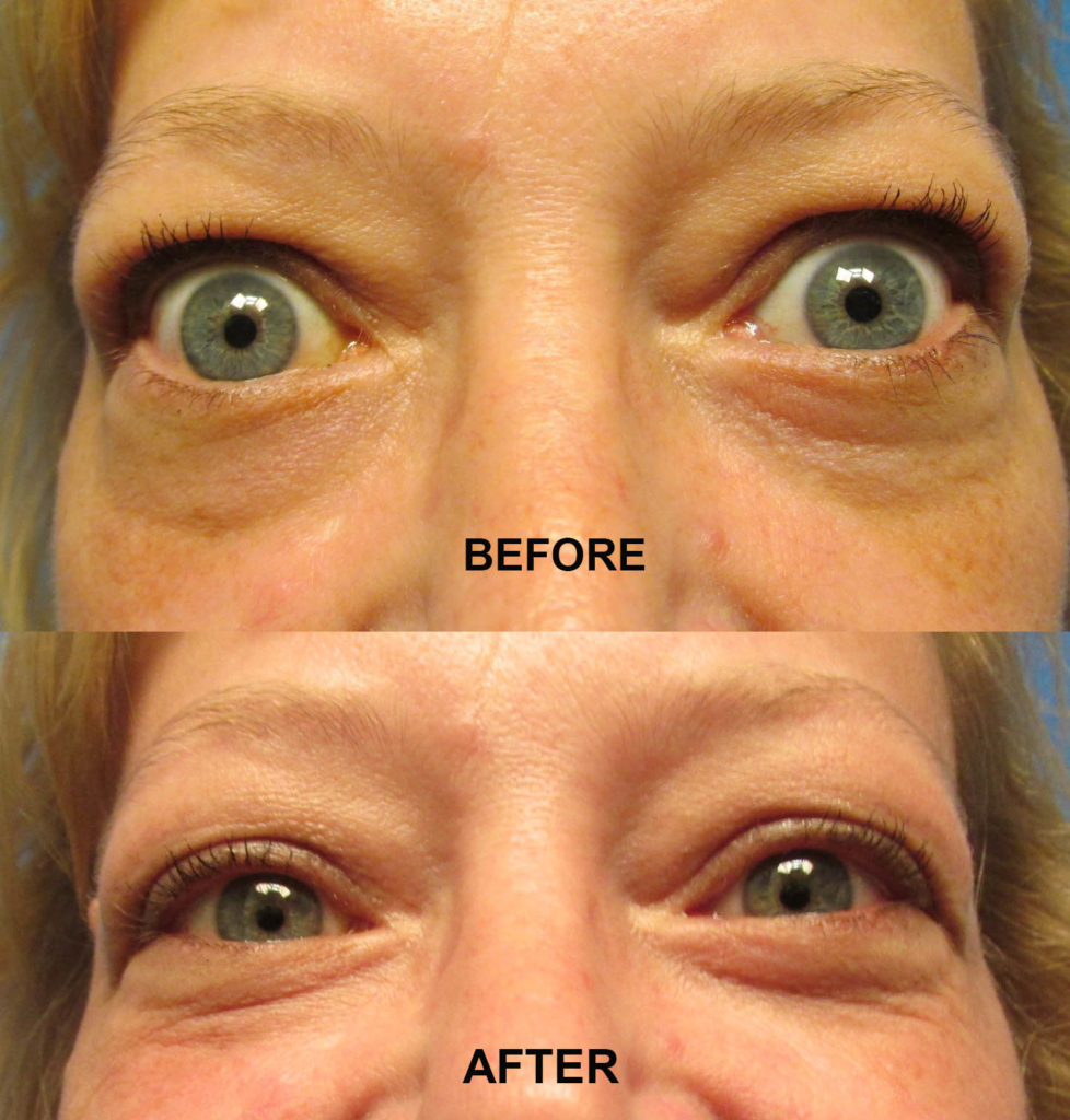 GRAVES DISEASE 5