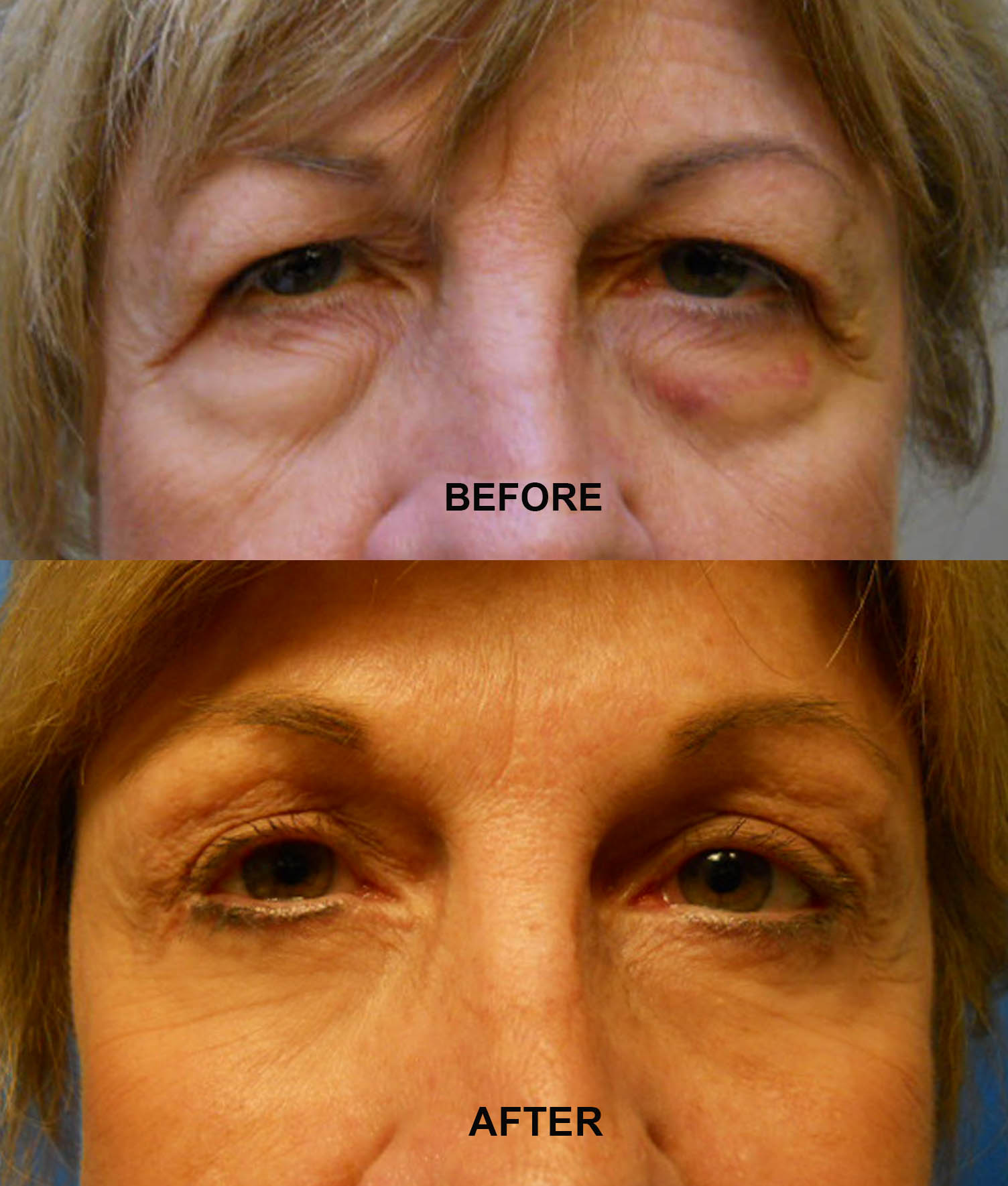 LOWER BLEPHAROPLASTY 23