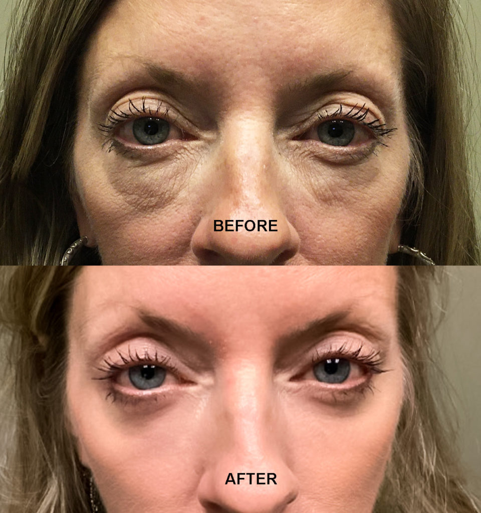 LASER RESURFACING 11