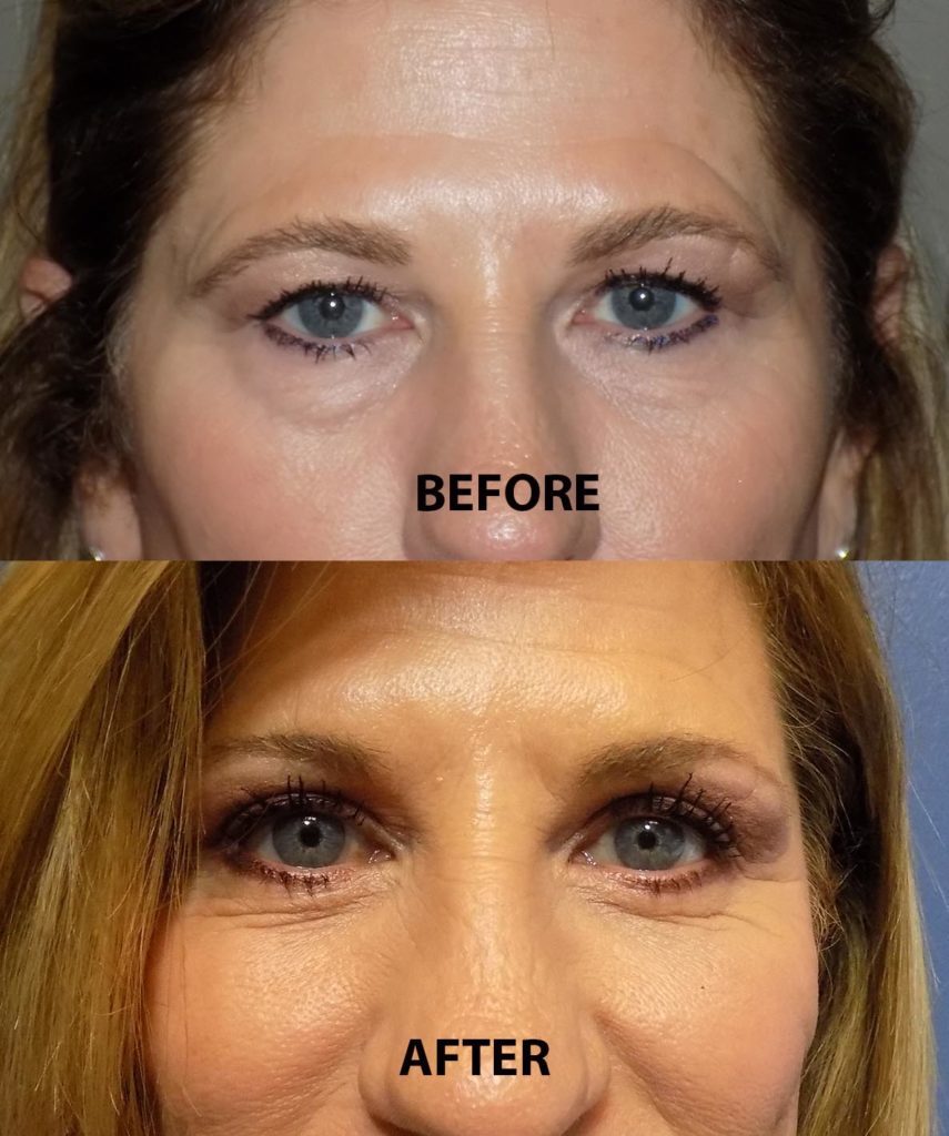 Treatments For Bags Under The Eyes - Dallas