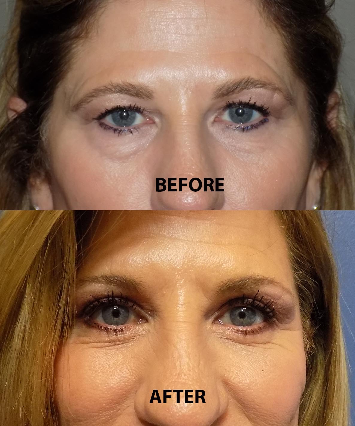 4 LID BLEPHAROPLASTY BEFORE AND AFTER