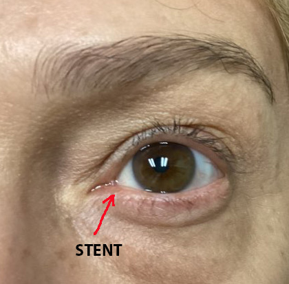 nld stent