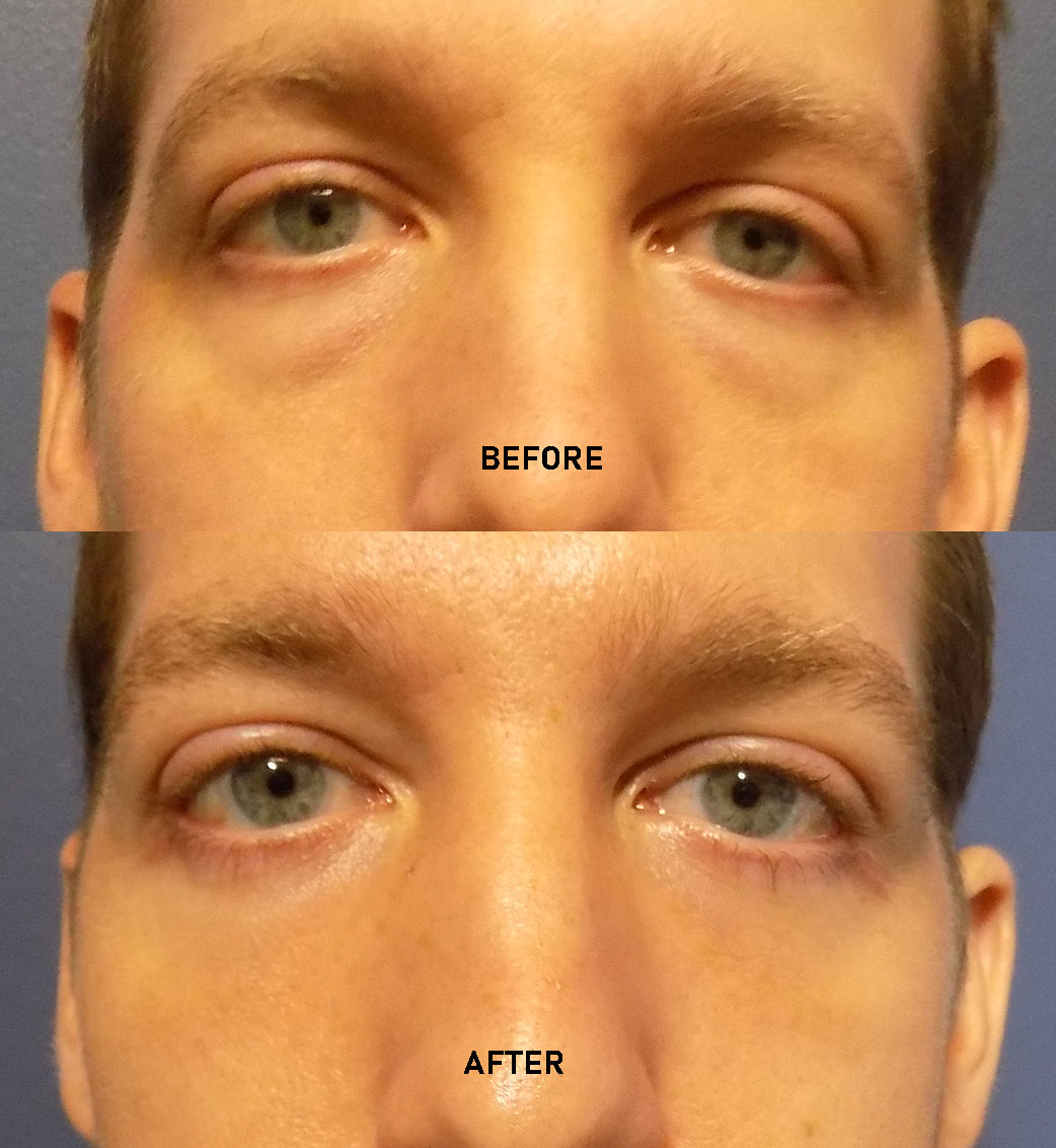 LOWER BLEPHAROPLASTY MALE
