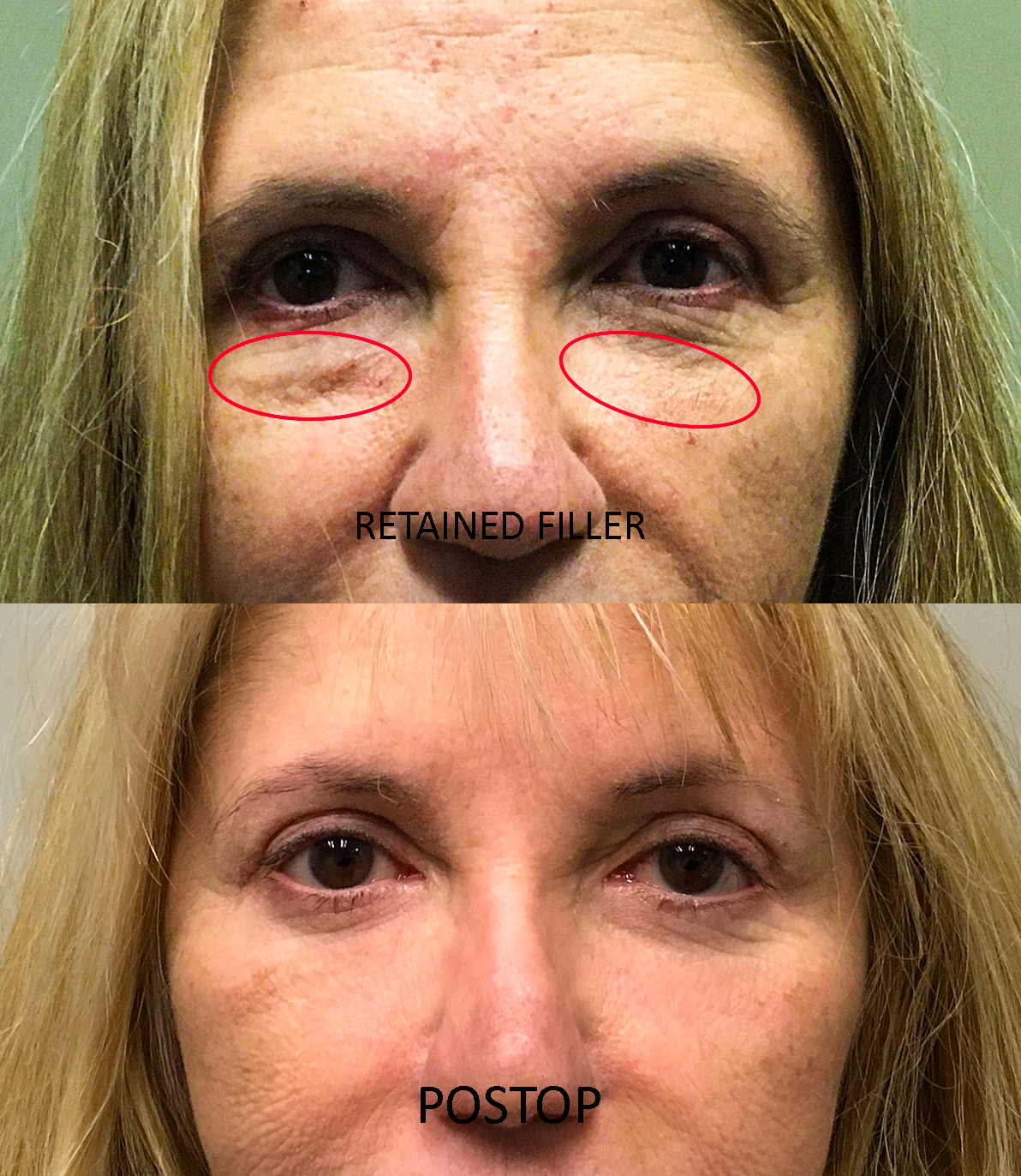 FILLER PRE AND POST 2