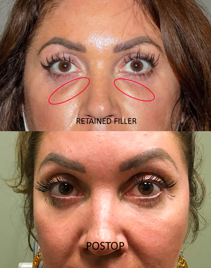 FILLER PRE AND POST 3