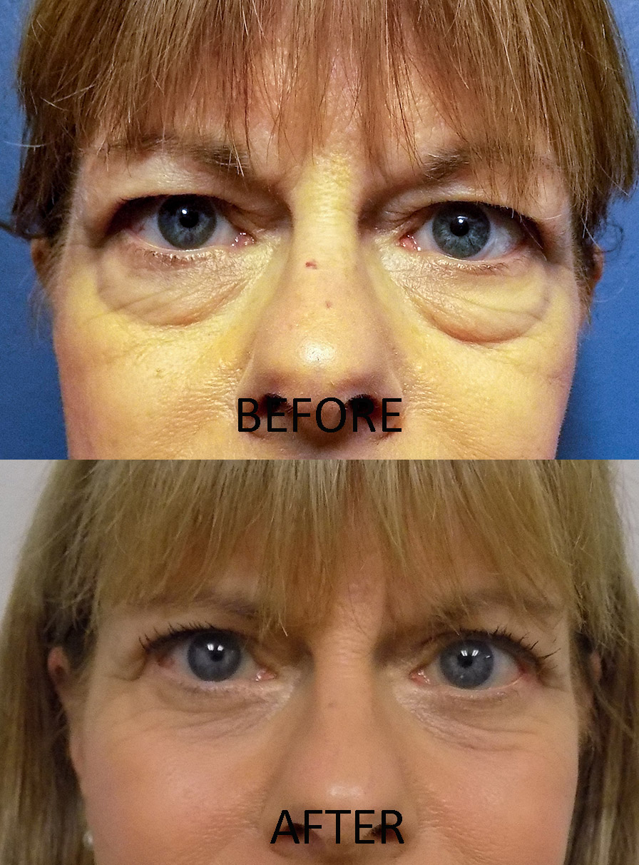 4 LID BLEPH PRE POST 30