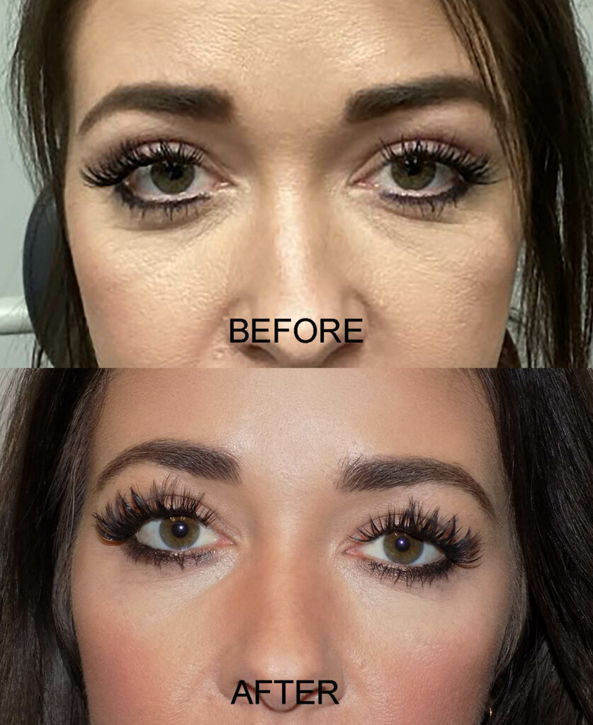 BLEPH PRE AND POST 30
