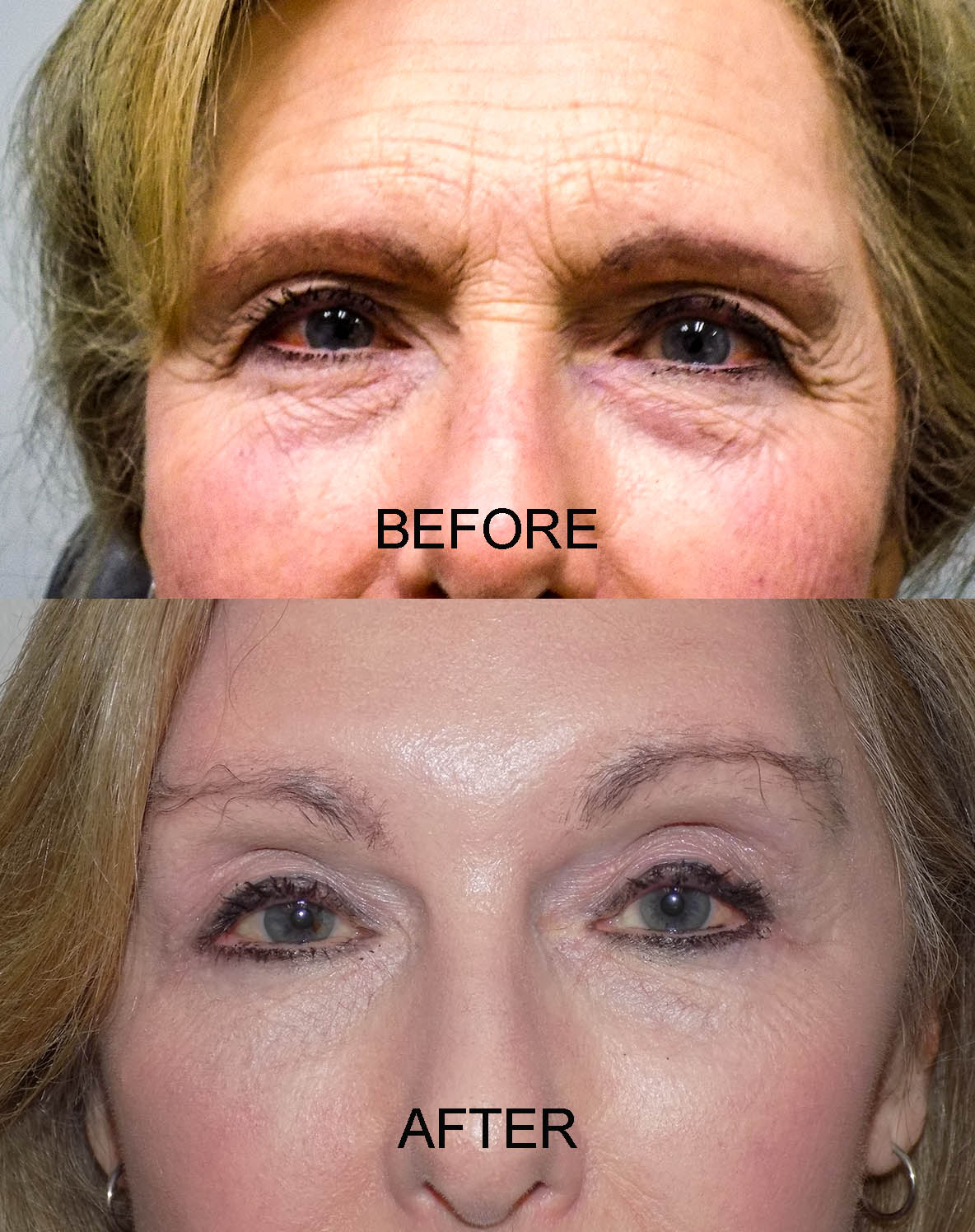 BLEPH PRE AND POST 31