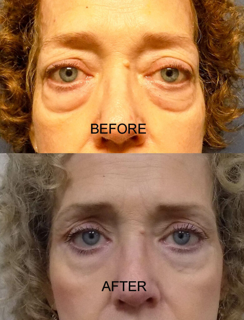 PRE AND POST 22