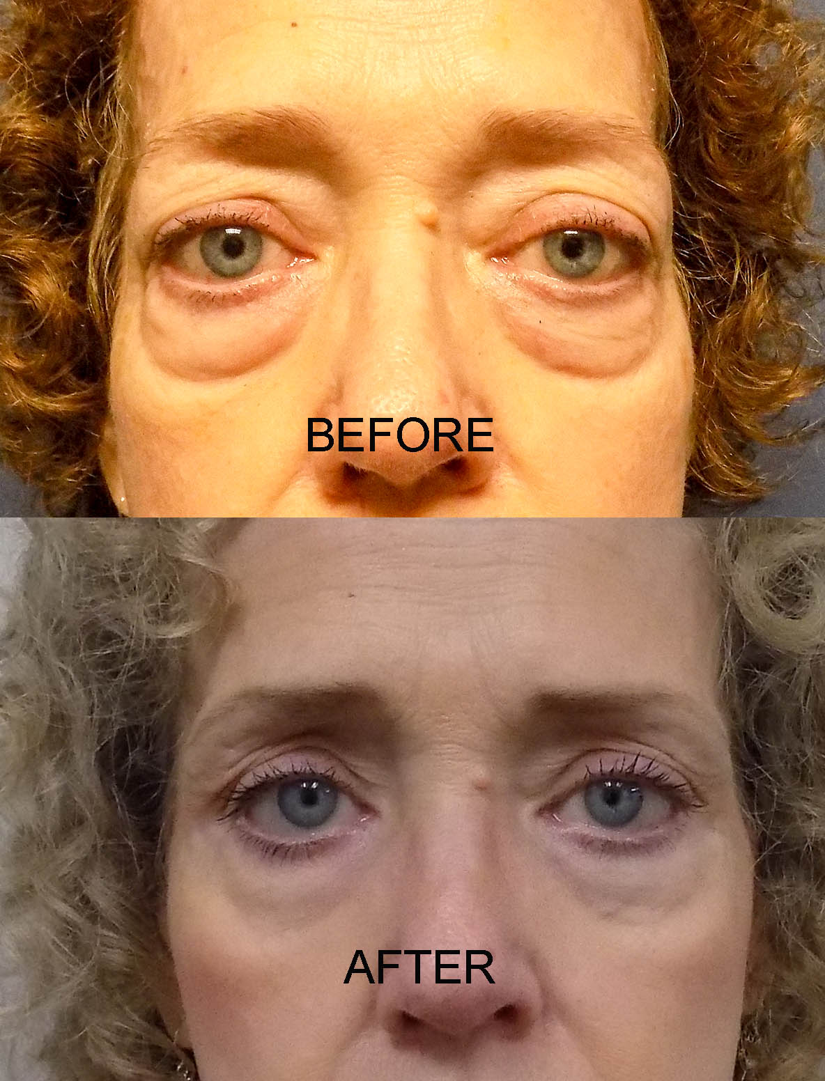 PRE AND POST 22