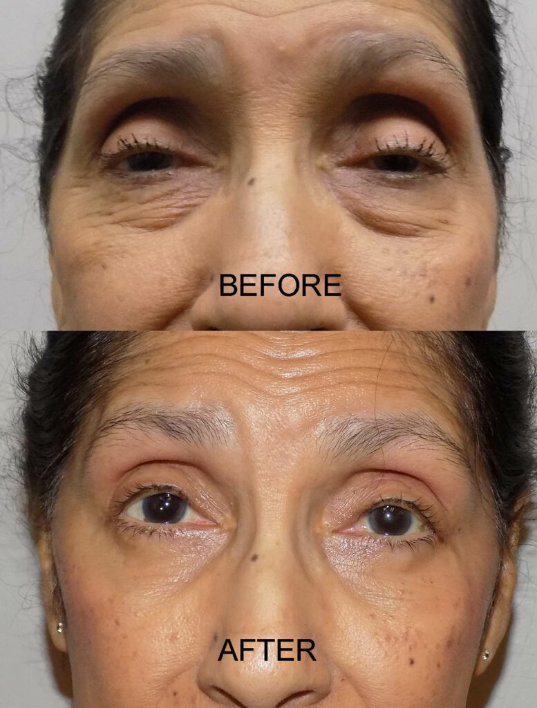 PTOSIS PRE AND POST