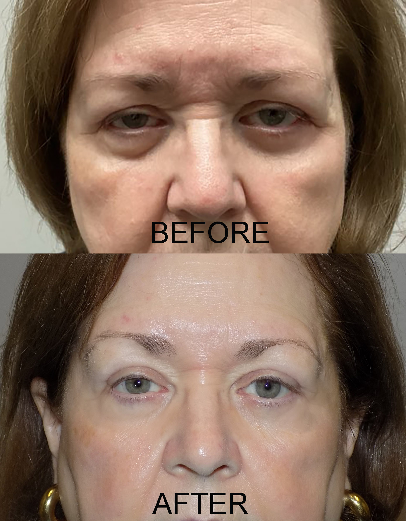 Browlift pre and post 9-3-24