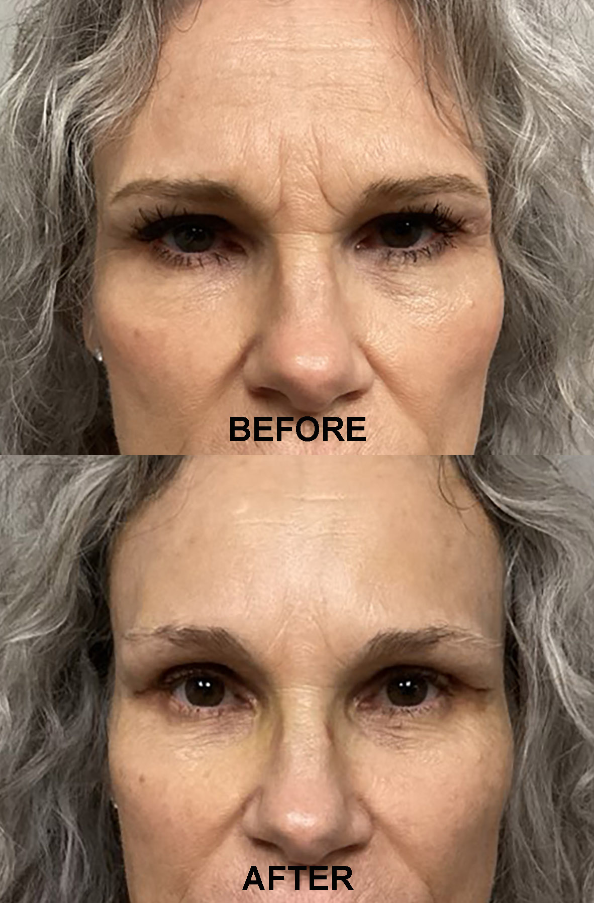 BROWLIFT PRE AND POST 25