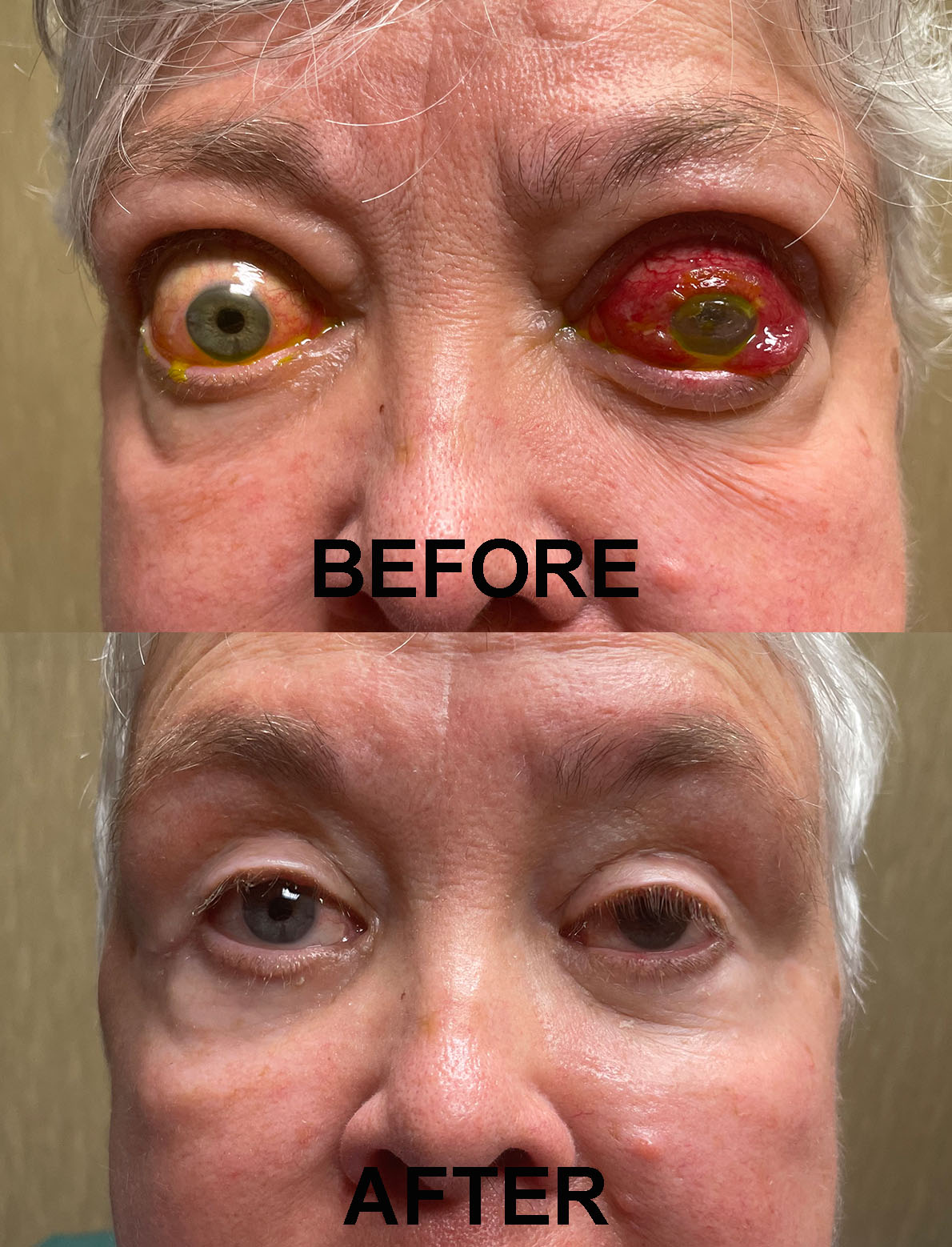 DECOMPRESSION PRE AND POST 20