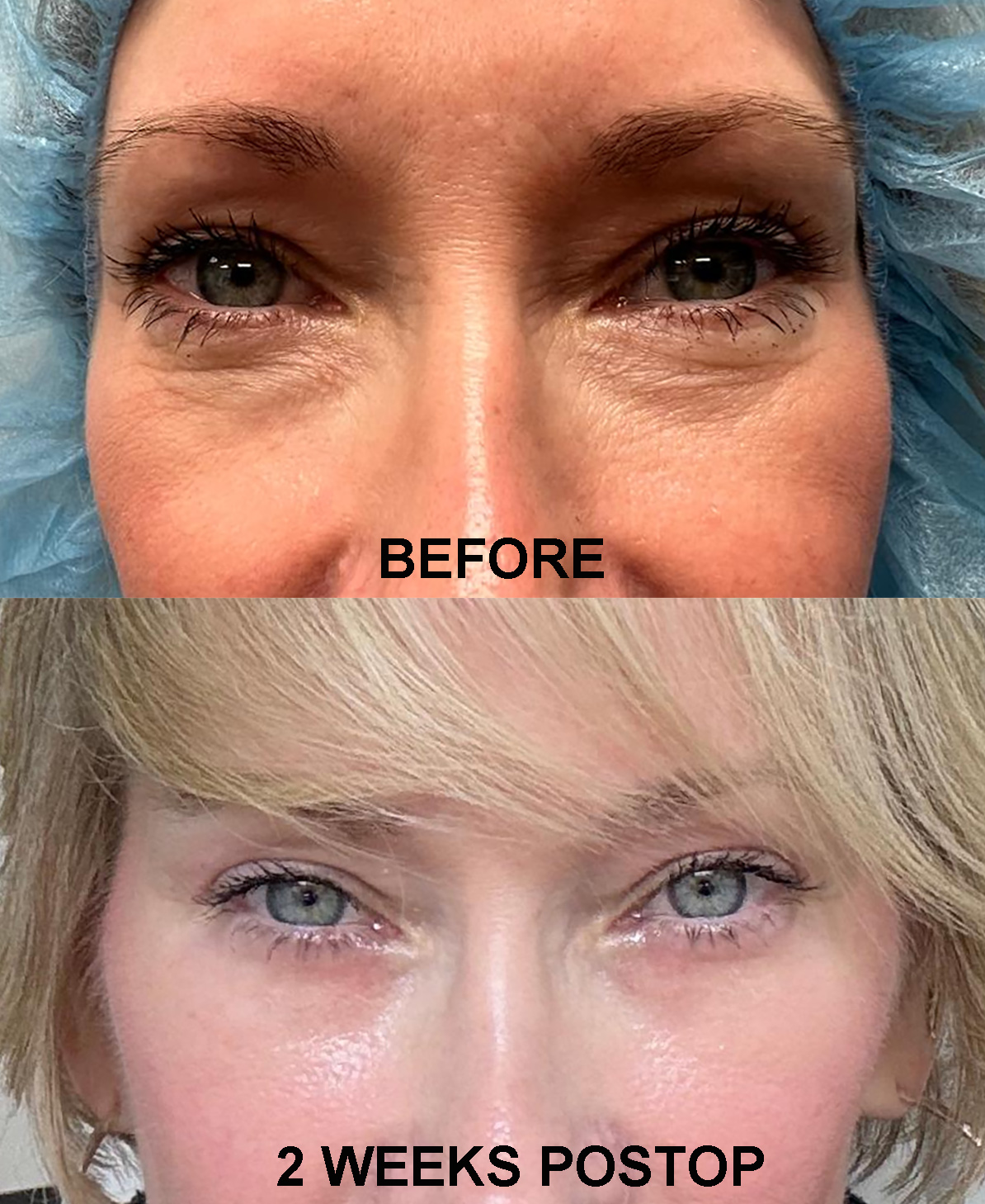 LASER PRE POST
