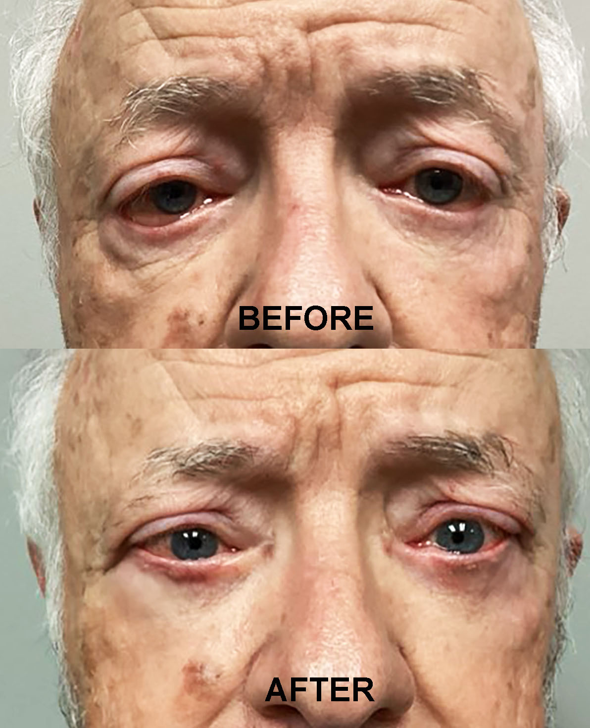 FASCIA LATA PRE POST