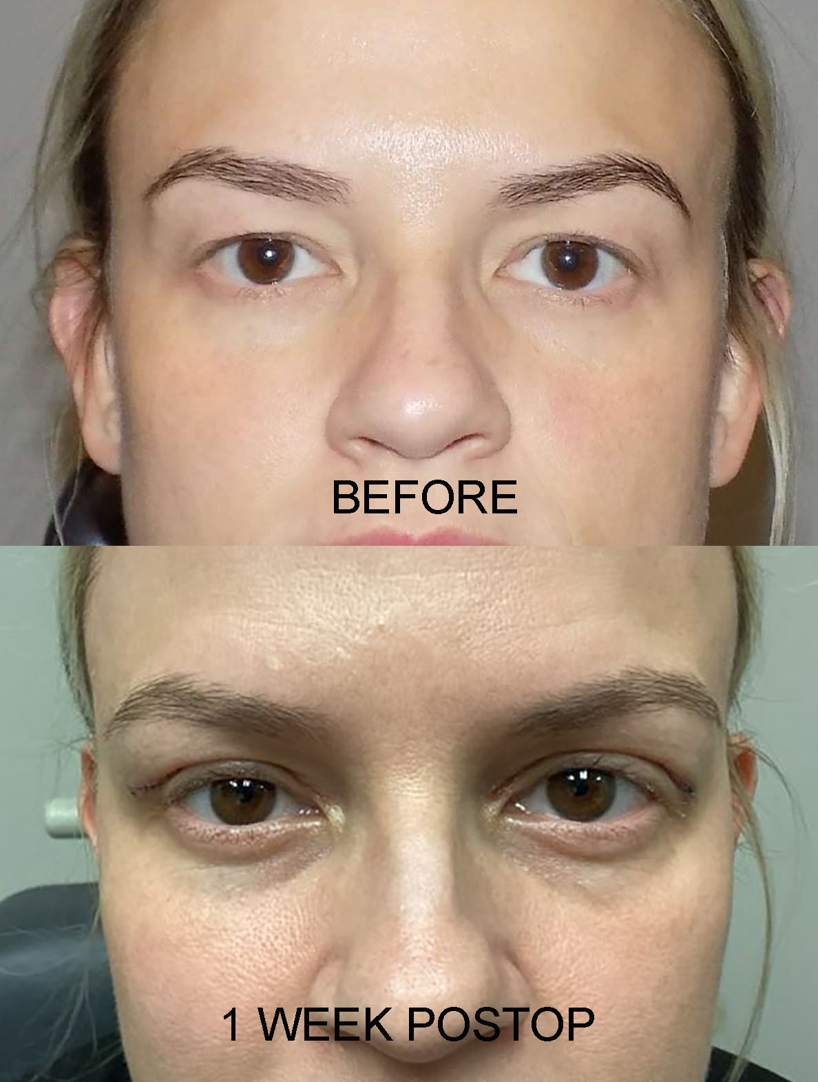 RICHARDSON PRE AND 1 WK PO
