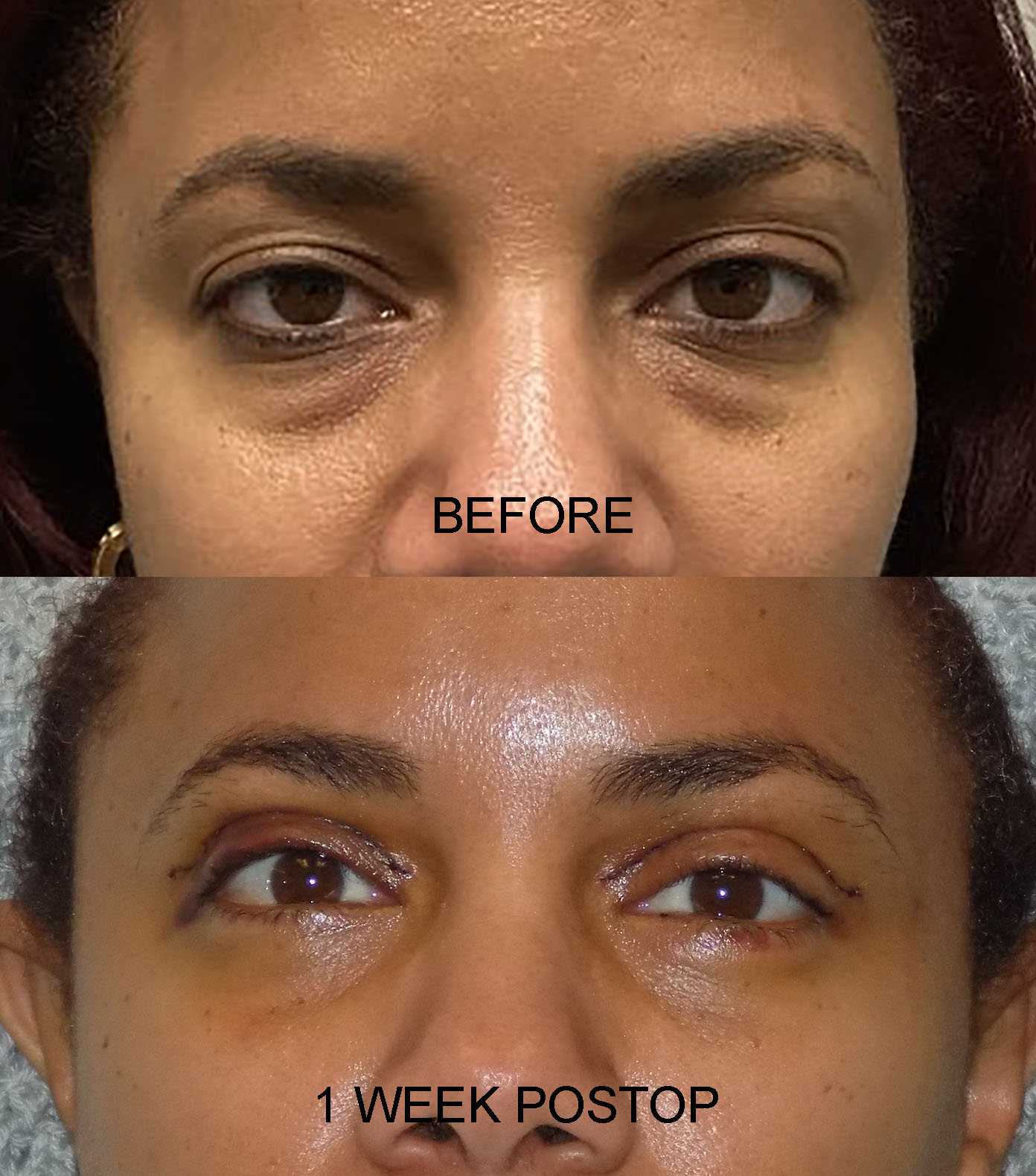 BLEPH PRE POST 35