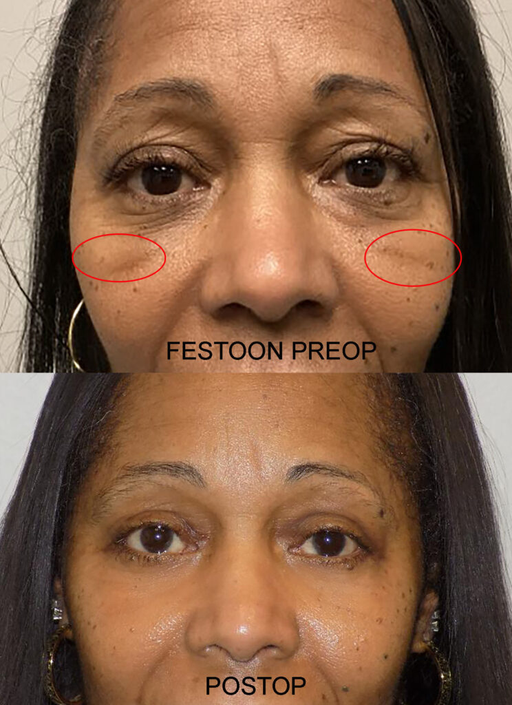 FESTOON PRE AND PO