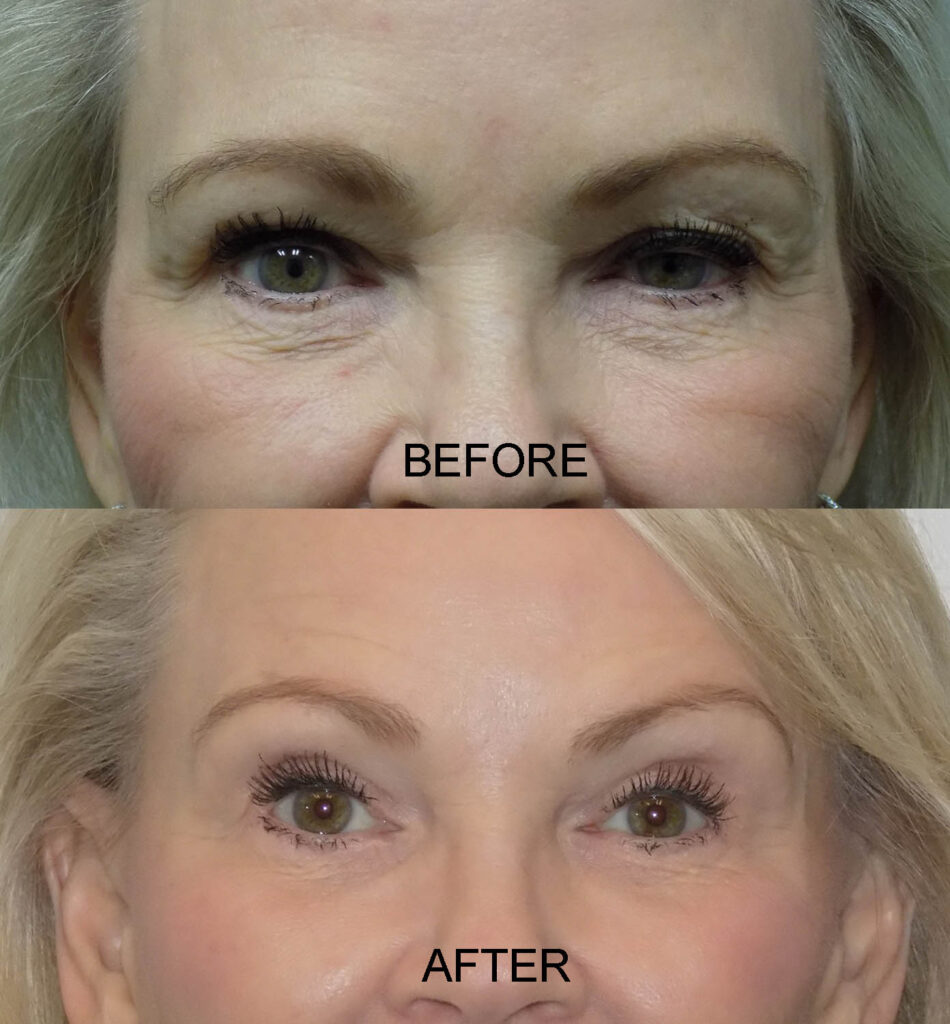 PTOSIS 14