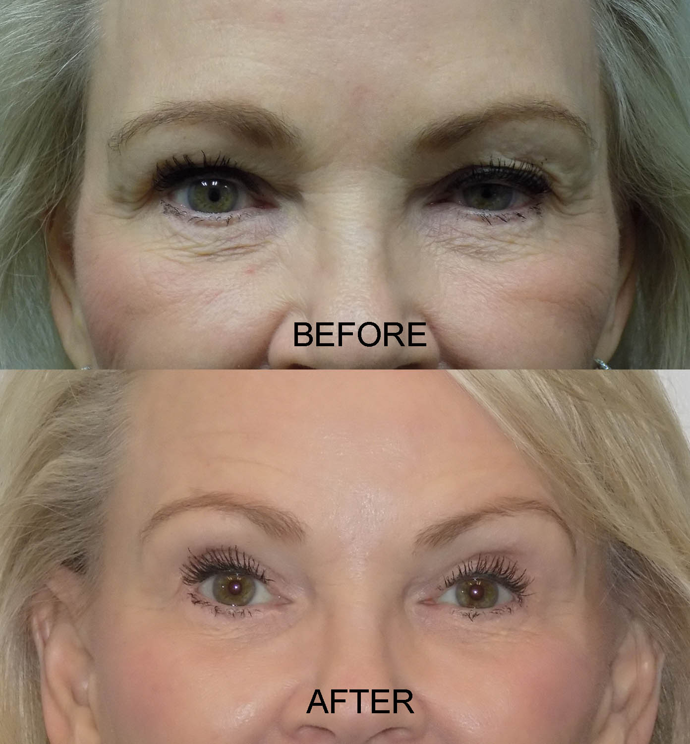 PTOSIS 14