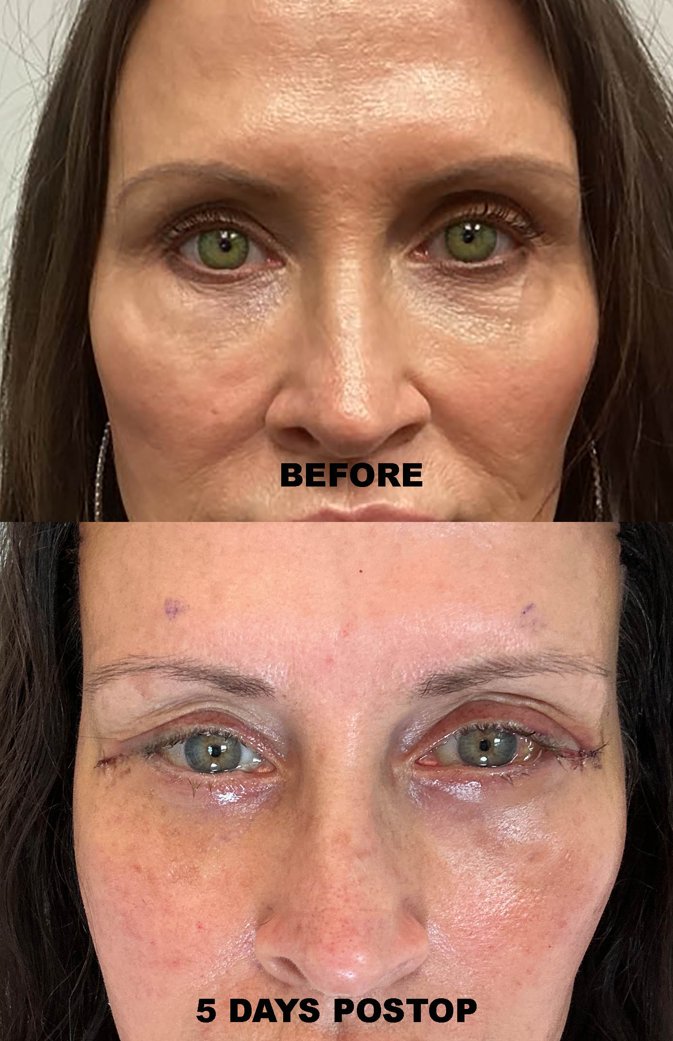 FILLER PRE AND POST 5